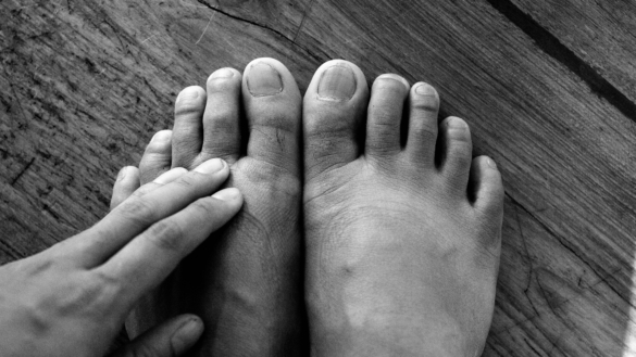 Diabetesfötter: orsak, symtom & behandling